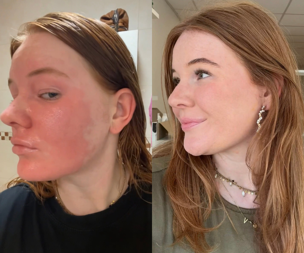Kyra laat before en after van haar eczeem zien